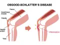 Illustrazione del morbo di Osgood Schlatter: il tendine rotuleo infiammato causa dolore e gonfiore sotto il ginocchio.