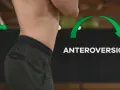 Vista laterale del busto di una persona che mostra un **tilt pelvico anteriore**, evidenziato da frecce verdi.