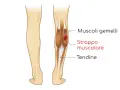 Illustrazione anatomica che mostra uno strappo muscolare ai gemelli della gamba, con evidenziato il danno ai muscoli e ai tendini.