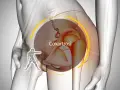 Illustrazione anatomica che evidenzia la coxartrosi, causa di dolore all'anca destra.