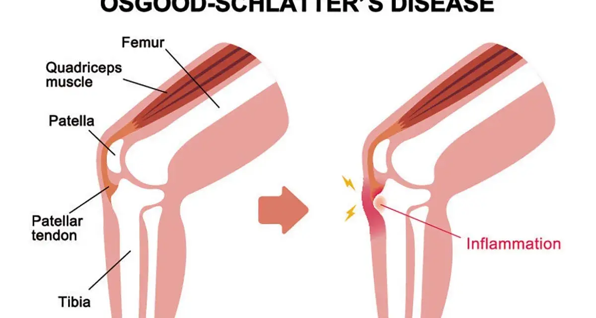 Illustrazione del morbo di Osgood Schlatter: il tendine rotuleo infiammato causa dolore e gonfiore sotto il ginocchio.