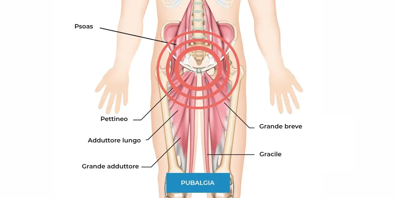 Illustrazione anatomica che mostra i muscoli adduttori e il psoas, evidenziando l'area della pubalgia. Difficoltà nel camminare.