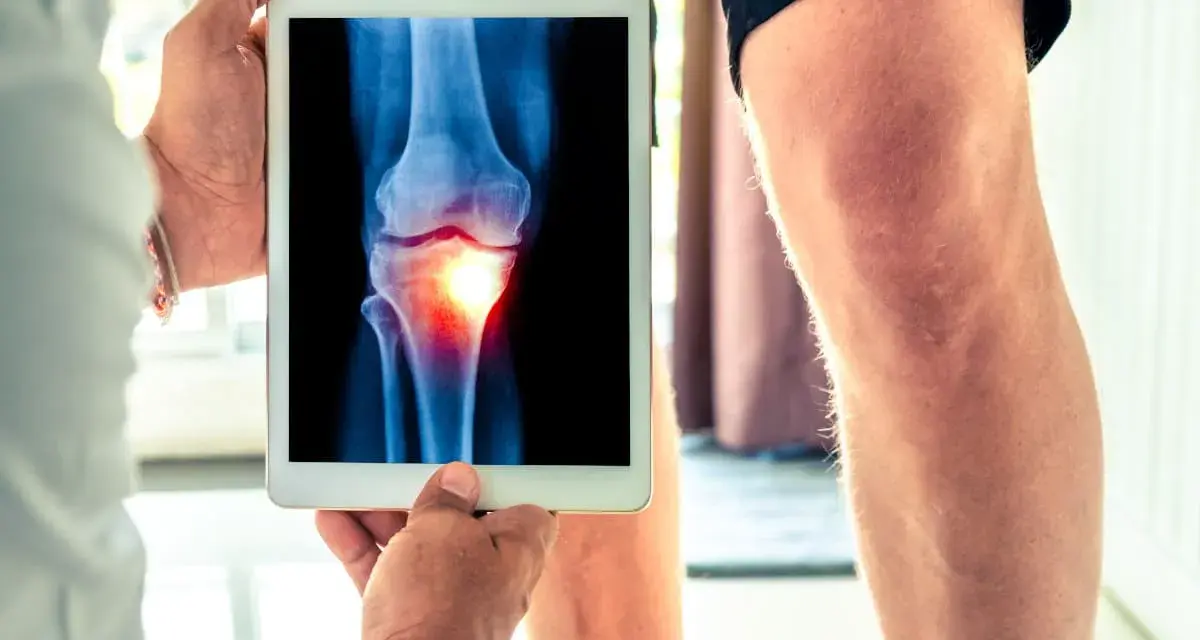 Medico mostra radiografia di un ginocchio con un'area infiammata, evidenziando un problema all'angolo q.