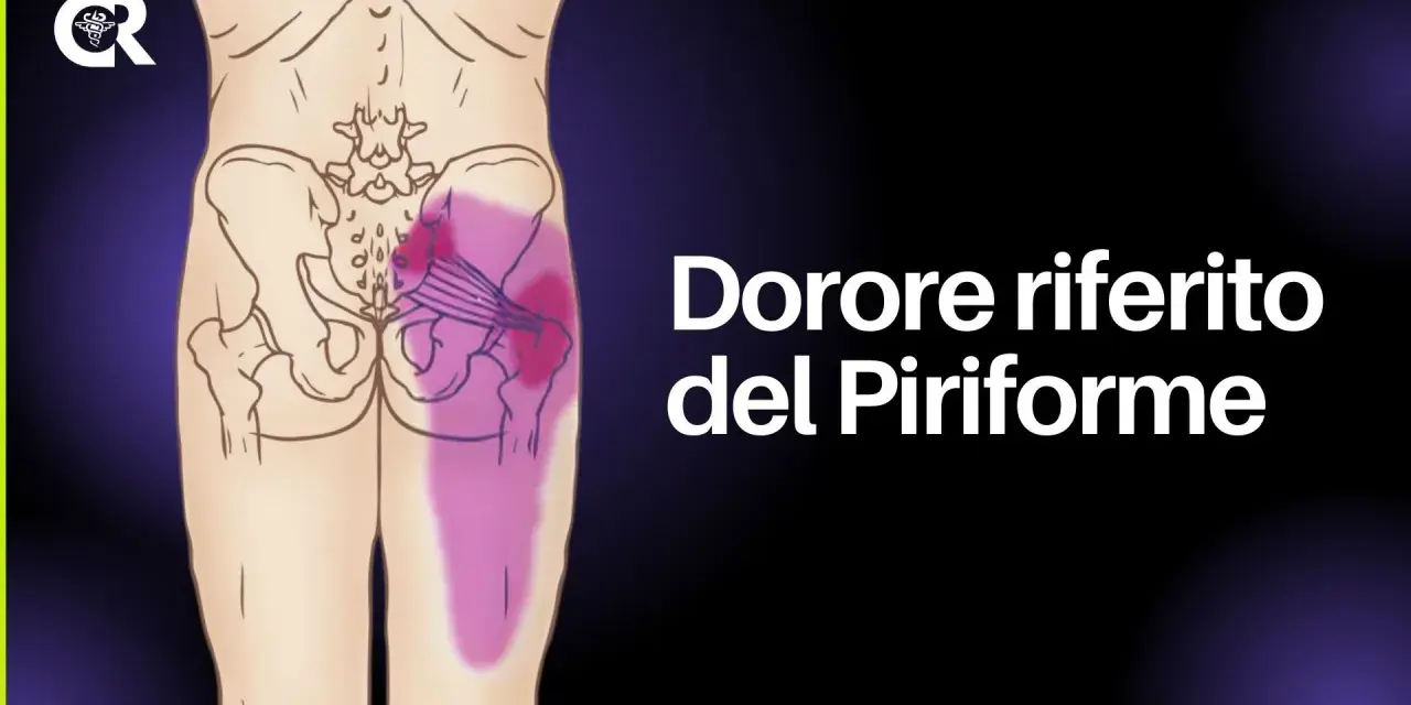 Dolore riferito del piriforme, un sintomo del deep gluteal syndrome, evidenziato in viola sull'anatomia del bacino e della gamba.