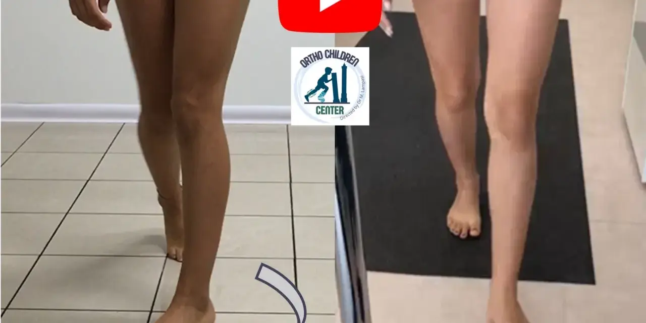 Confronto tra due posture: a) gamba con evidente intrarotazione dell'anca; b) gamba con correzione.