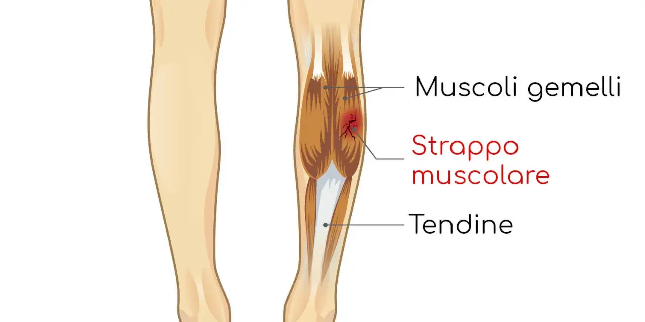 Illustrazione anatomica che mostra uno strappo muscolare ai gemelli della gamba, con evidenziato il danno ai muscoli e ai tendini.