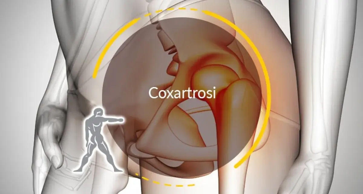 Illustrazione anatomica che evidenzia la coxartrosi, causa di dolore all'anca destra.
