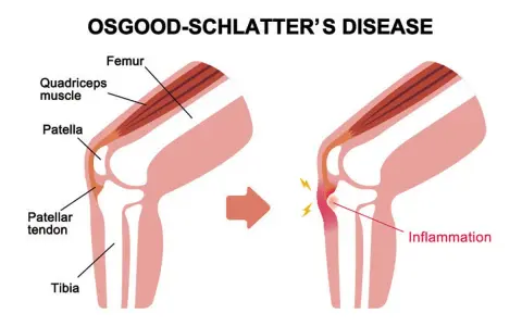 Illustrazione del morbo di Osgood Schlatter: il tendine rotuleo infiammato causa dolore e gonfiore sotto il ginocchio.