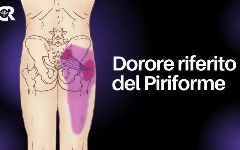 Dolore riferito del piriforme, un sintomo del deep gluteal syndrome, evidenziato in viola sull'anatomia del bacino e della gamba.