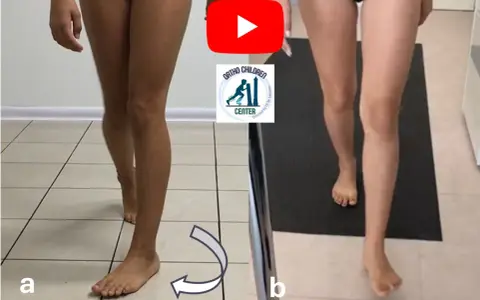 Confronto tra due posture: a) gamba con evidente intrarotazione dell'anca; b) gamba con correzione.
