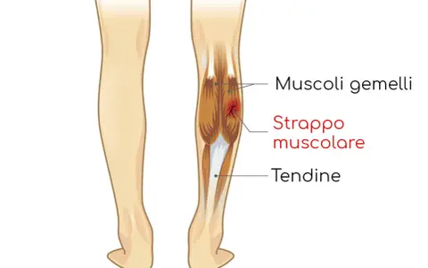 Illustrazione anatomica che mostra uno strappo muscolare ai gemelli della gamba, con evidenziato il danno ai muscoli e ai tendini.