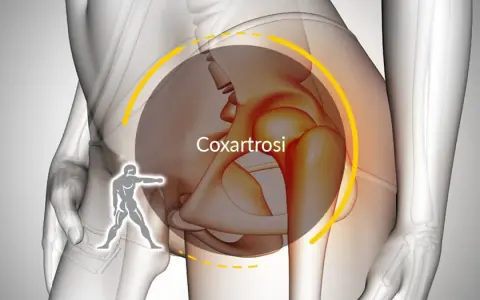 Illustrazione anatomica che evidenzia la coxartrosi, causa di dolore all'anca destra.