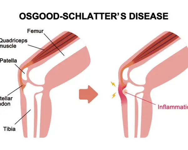 Illustrazione del morbo di Osgood Schlatter: il tendine rotuleo infiammato causa dolore e gonfiore sotto il ginocchio.