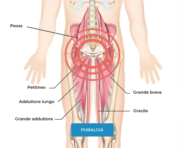 Illustrazione anatomica che mostra i muscoli adduttori e il psoas, evidenziando l'area della pubalgia. Difficoltà nel camminare.