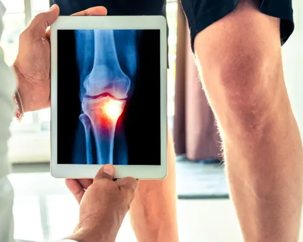 Medico mostra radiografia di un ginocchio con un'area infiammata, evidenziando un problema all'angolo q.