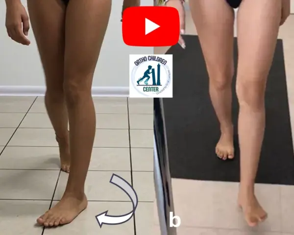 Confronto tra due posture: a) gamba con evidente intrarotazione dell'anca; b) gamba con correzione.