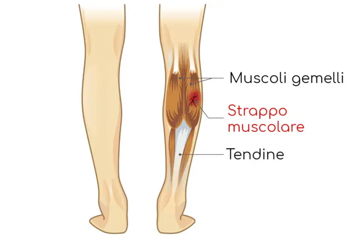 Illustrazione anatomica che mostra uno strappo muscolare ai gemelli della gamba, con evidenziato il danno ai muscoli e ai tendini.