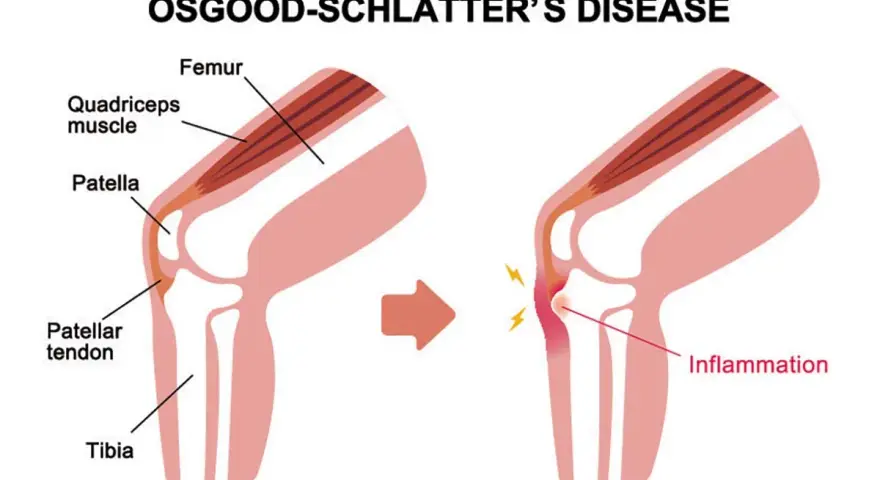 Illustrazione del morbo di Osgood Schlatter: il tendine rotuleo infiammato causa dolore e gonfiore sotto il ginocchio.