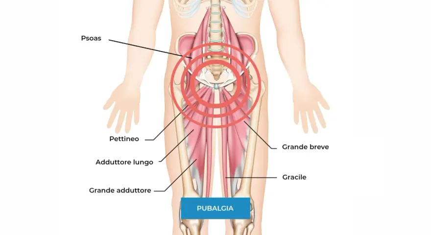 Illustrazione anatomica che mostra i muscoli adduttori e il psoas, evidenziando l'area della pubalgia. Difficoltà nel camminare.
