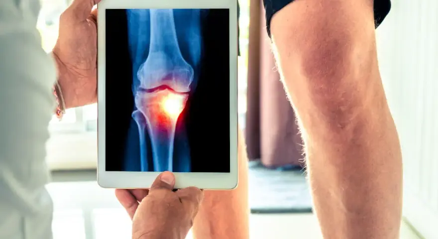 Medico mostra radiografia di un ginocchio con un'area infiammata, evidenziando un problema all'angolo q.