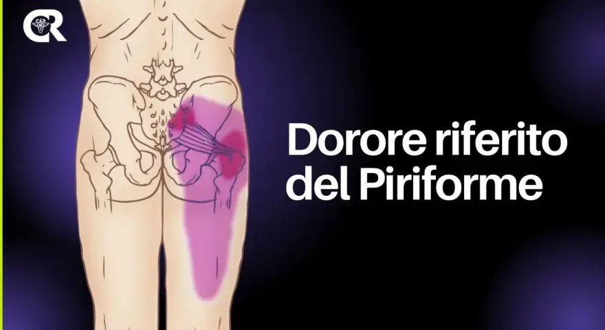 Dolore riferito del piriforme, un sintomo del deep gluteal syndrome, evidenziato in viola sull'anatomia del bacino e della gamba.