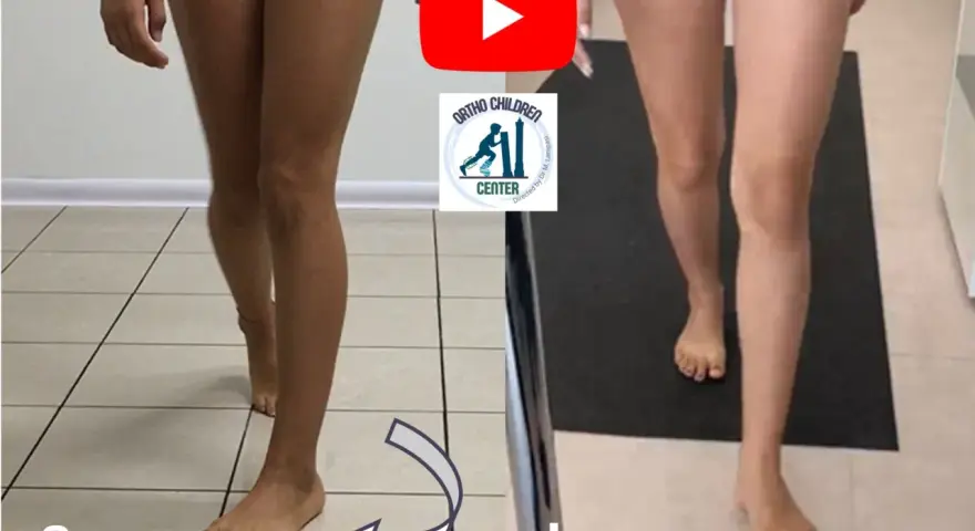 Confronto tra due posture: a) gamba con evidente intrarotazione dell'anca; b) gamba con correzione.