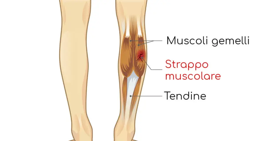 Illustrazione anatomica che mostra uno strappo muscolare ai gemelli della gamba, con evidenziato il danno ai muscoli e ai tendini.