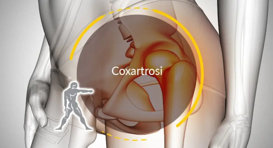 Illustrazione anatomica che evidenzia la coxartrosi, causa di dolore all'anca destra.