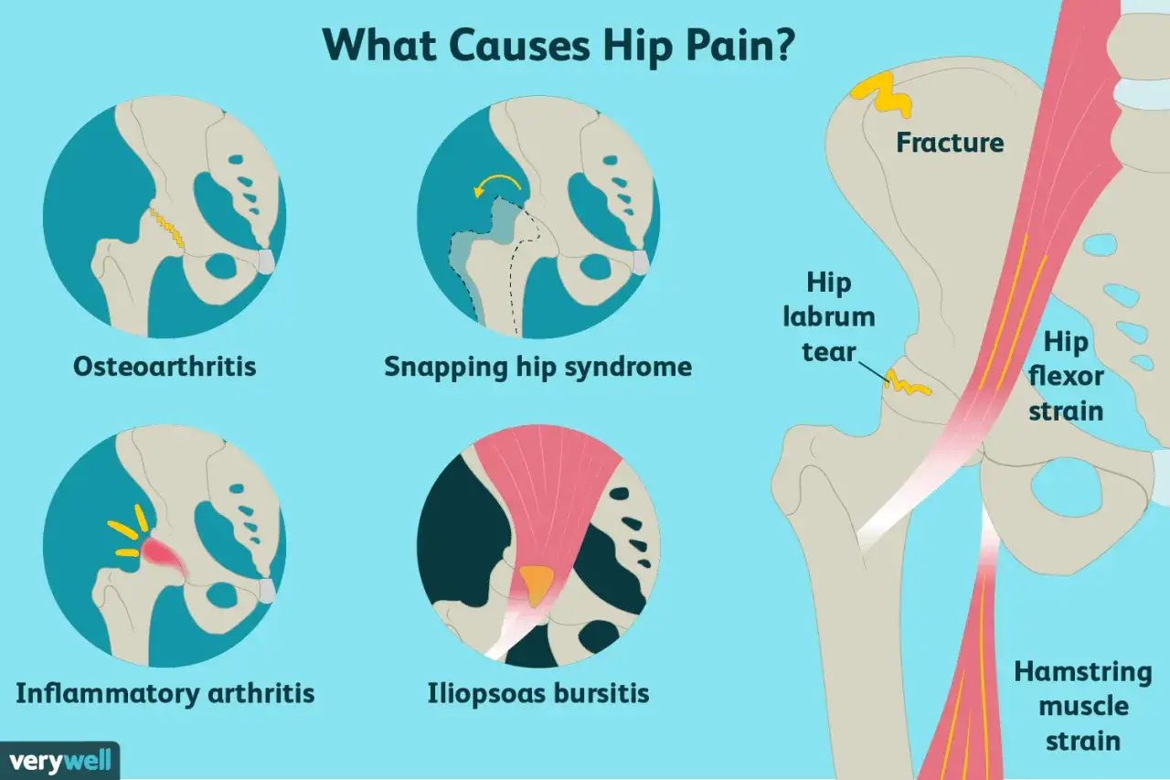 Illustrazione medica che mostra le cause del dolore all'anca quando cammino: osteoartrite, sindrome dell'anca a scatto, artrite infiammatoria, borsite ileopsoas, frattura, lesione del labbro acetabolare, stiramento del flessore dell'anca e stiramento d...
