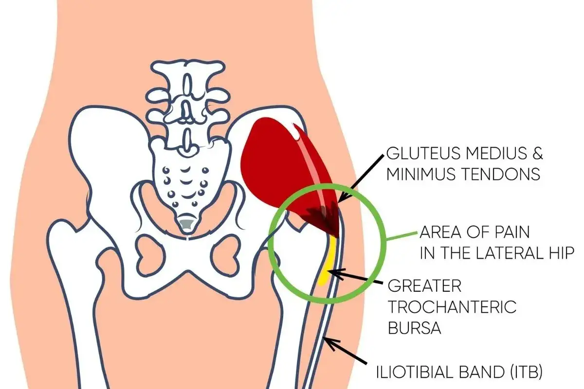 Illustrazione anatomica che mostra la causa del dolore all'anca dopo la corsa: infiammazione dei tendini del gluteo medio/minimo e della borsa trocanterica.