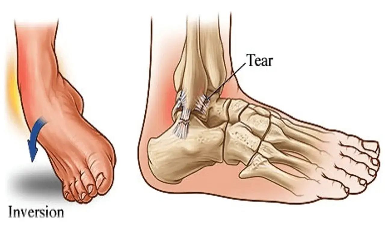 Dettaglio anatomico dell'articolazione talocrurale con evidenziato uno strappo ai legamenti, causato da un movimento di inversione del piede.