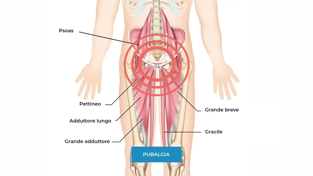 Illustrazione anatomica che mostra i muscoli adduttori e psoas, con cerchi rossi che indicano l'area del dolore. Utile per capire se e pubalgia.