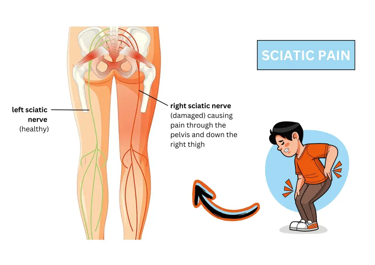 Dolore al nervo sciatico infiammato: illustrazione anatomica mostra il nervo sciatico destro danneggiato, causando dolore.