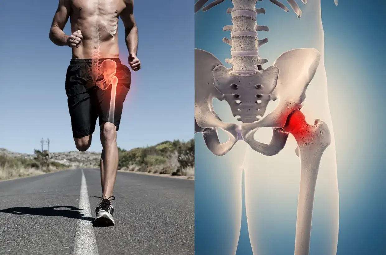 Un corridore con evidenziata la coxalgia all'anca. Anatomia scheletrica dell'anca con dolore localizzato in rosso.