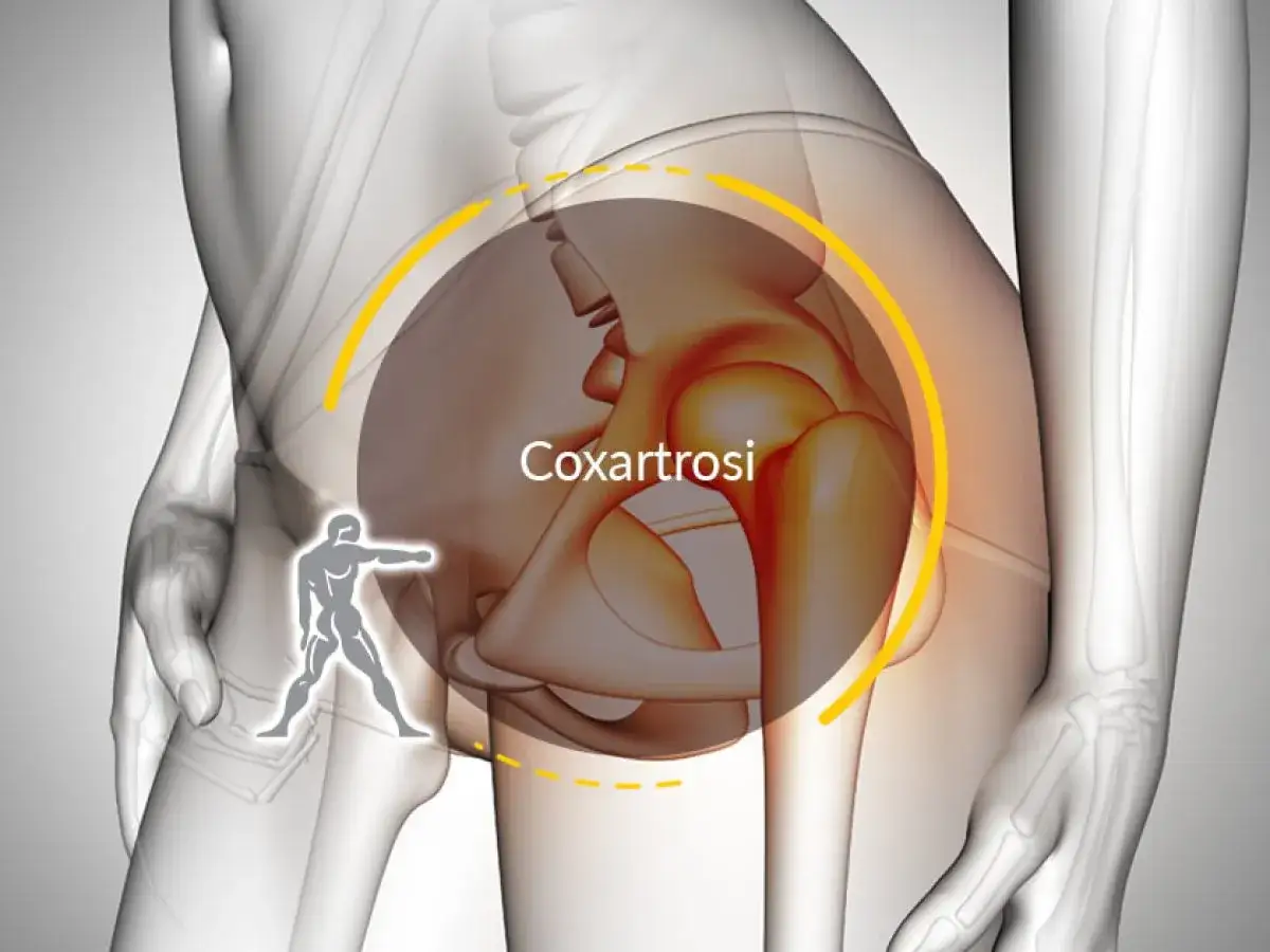 Illustrazione anatomica che evidenzia la coxartrosi, causa di dolore all'anca destra.