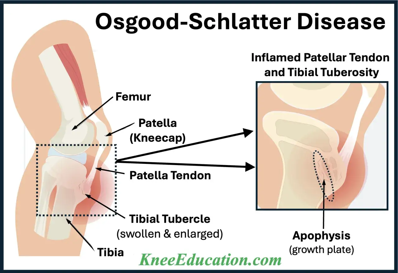 Illustrazione anatomica del morbo di Osgood Schlatter, che mostra l'infiammazione del tendine rotuleo e della tuberosità tibiale, con conseguenze sulla crescita.